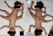'Gêmeos aranha': siameses que nasceram com sete membros passam por cirurgia
