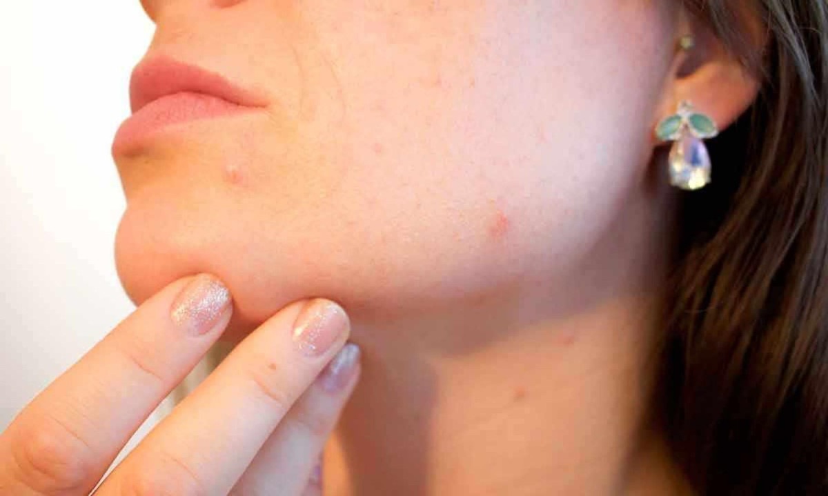 Aparecimento de acne em adultos está ligado às oscilações de hormônios, alimentação e até estresse
 -  (crédito: PIXABAY/REPRODUÇÃO)