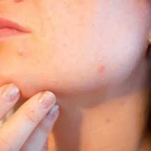 Acne na fase adulta: quais as causas? Existem tratamentos e prevenção? - PIXABAY/REPRODUÇÃO