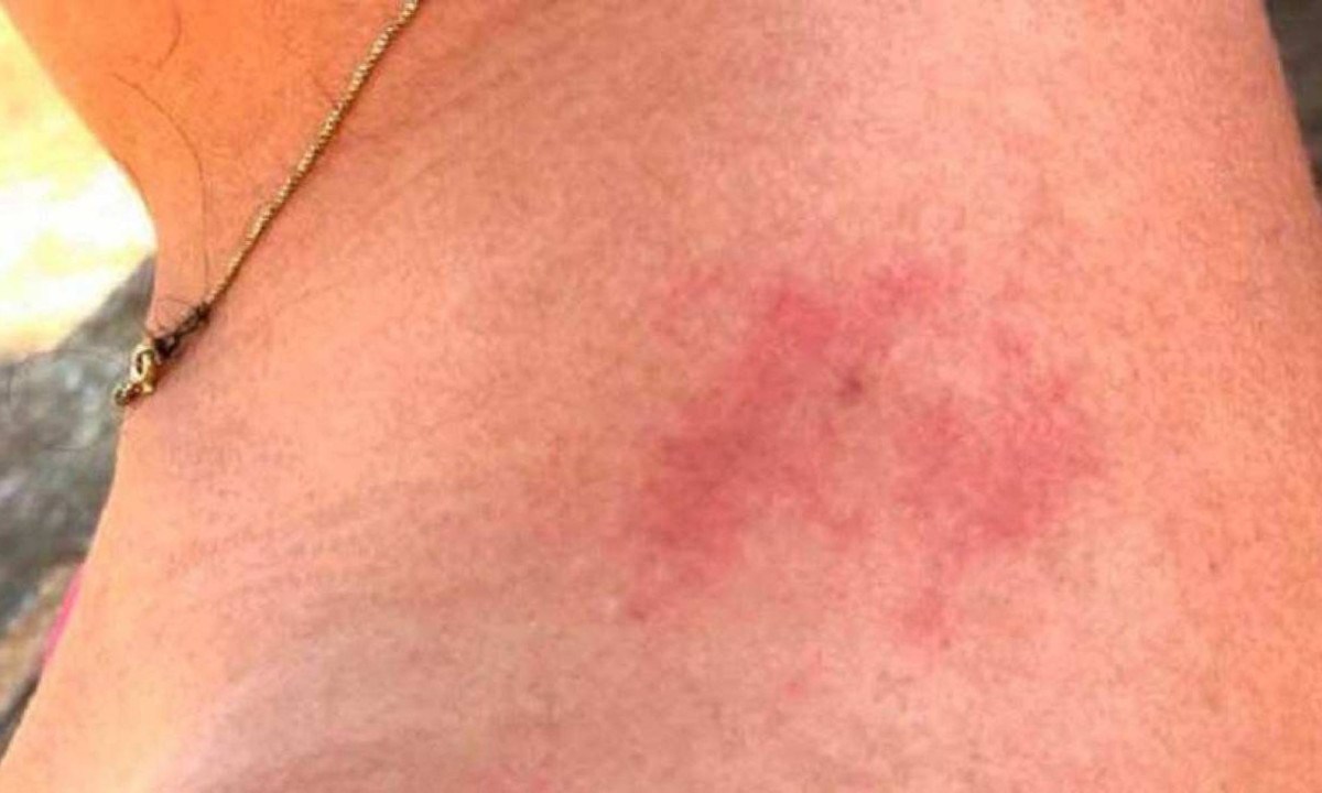 Marcas apresentadas de agressão no ombro -  (crédito: Divulgação/PMMG)