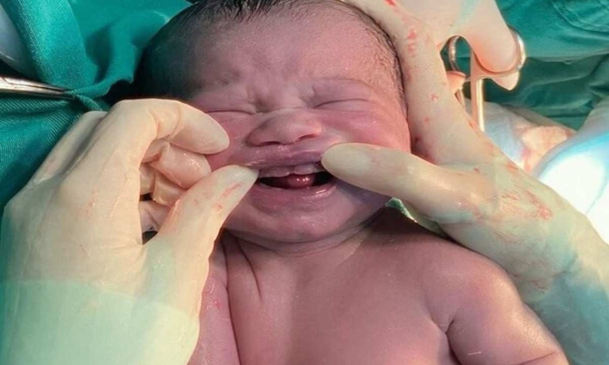Obstetra registra caso de bebê que nasceu com seis dentes -  (crédito: Reprodução)