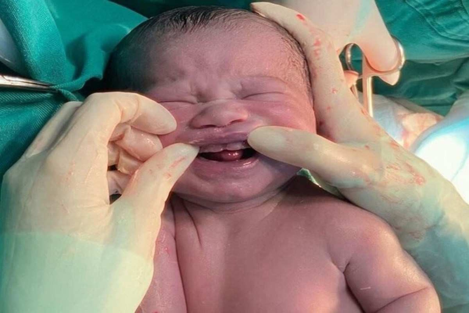 Bebê nasce com dentes e viraliza na web; entenda