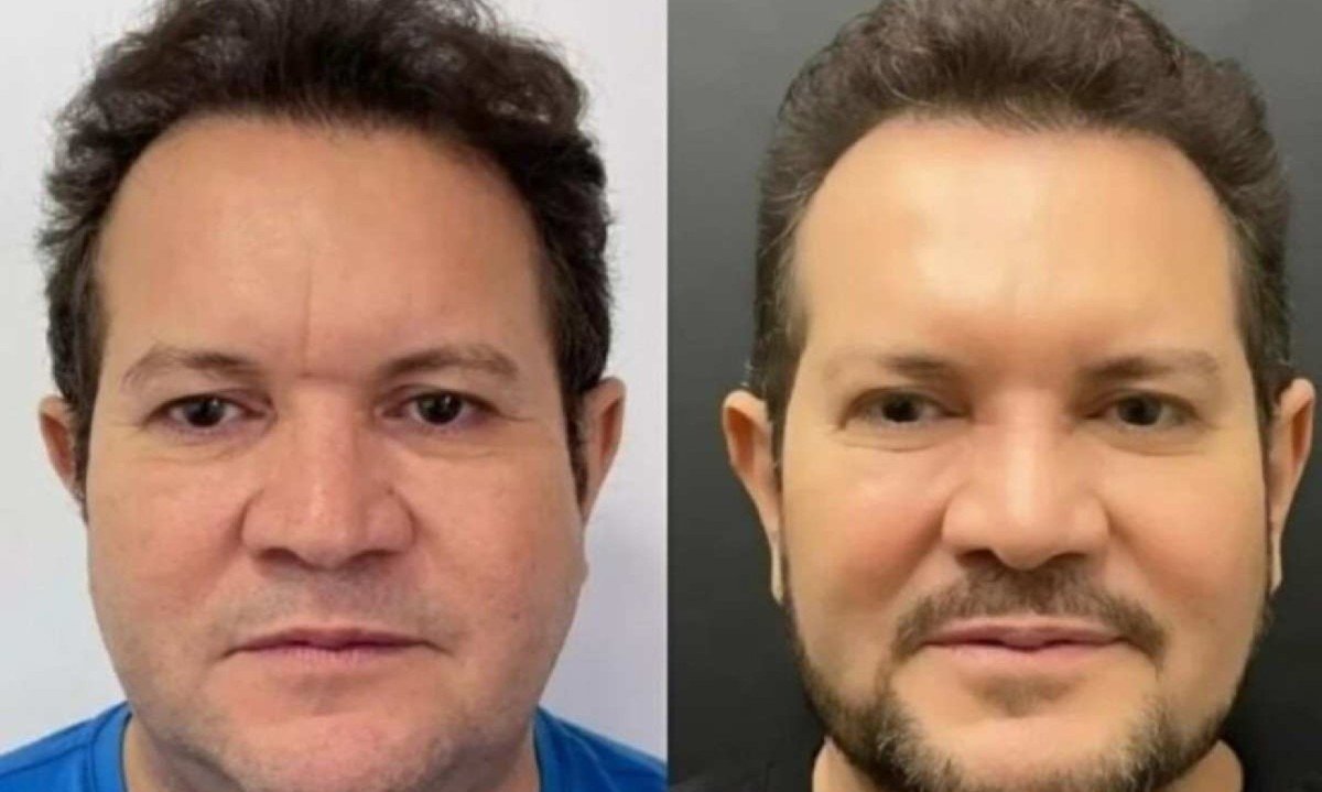 Antes e depois de Ximbinha -  (crédito: Reprodução/Instagram)