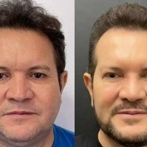 Ximbinha faz harmonização facial e web comenta: 'Gato demais' - Reprodução/Instagram