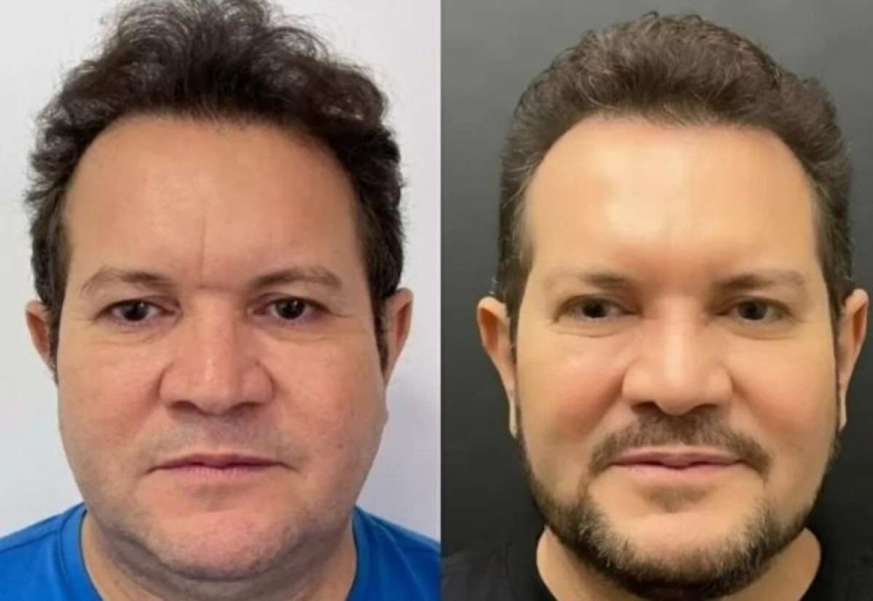 Ximbinha faz harmonização facial e web comenta: 'Gato demais'