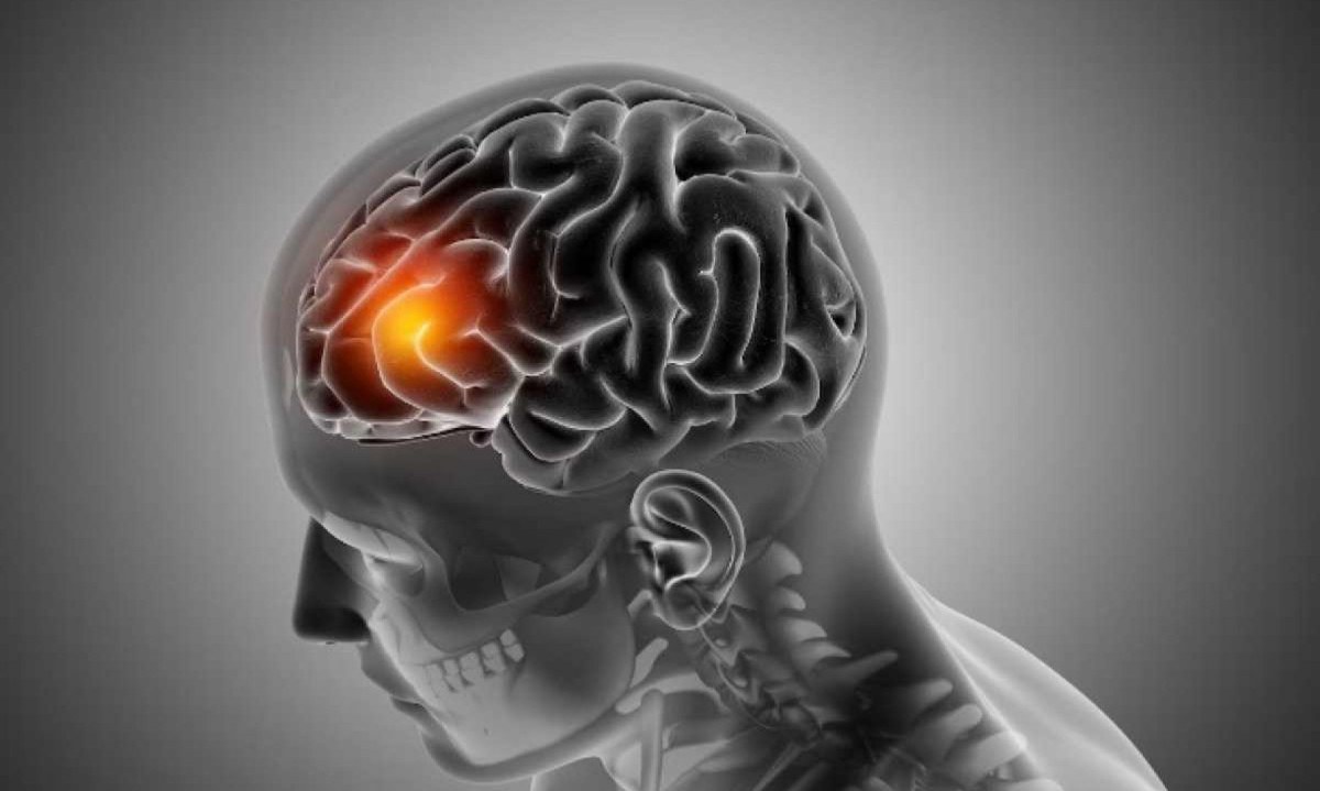 Causado pelo bloqueio de vasos sanguíneos cerebrais, o AVC exige diagnóstico rápido e tratamento eficaz  -  (crédito: Freepik)