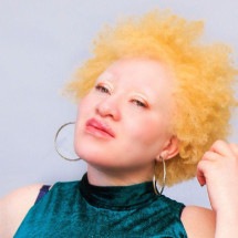 'Meu estuprador acreditava que atacar uma pessoa albina o protegeria de doenças' - Handout