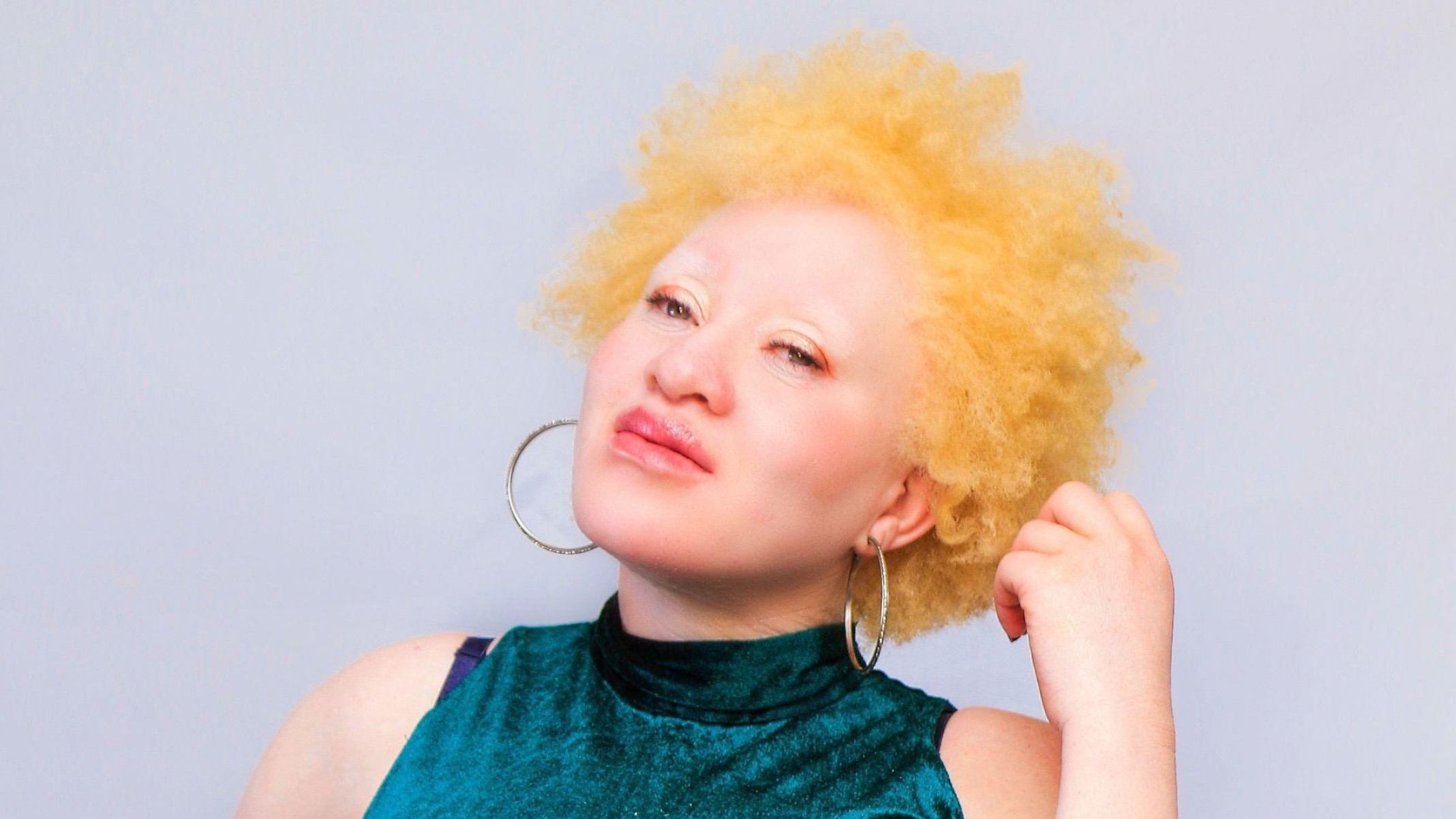'Meu estuprador acreditava que atacar uma pessoa albina o protegeria de doenças'
