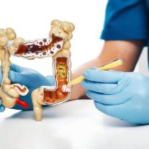 Mulher descobre câncer de intestino após ignorar sintomas por três anos - Shutterstock/Divulgação