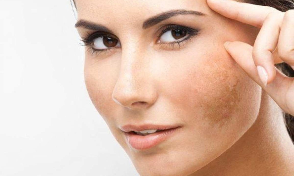 O melasma pode ocorrer em homens e mulheres de todas as etnias e tipos de pele, mas é especialmente prevalente em mulheres, podendo afetar até 30% daquelas em idade reprodutiva

 -  (crédito: Freepik)