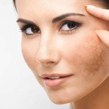 Novo ativo promete suavizar manchas como de melasma sem clarear a pele - Freepik