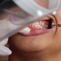 Descoberta substância (secretada por fungos) para combater cárie dental - Laísa Queiroz/Ministério da Saúde