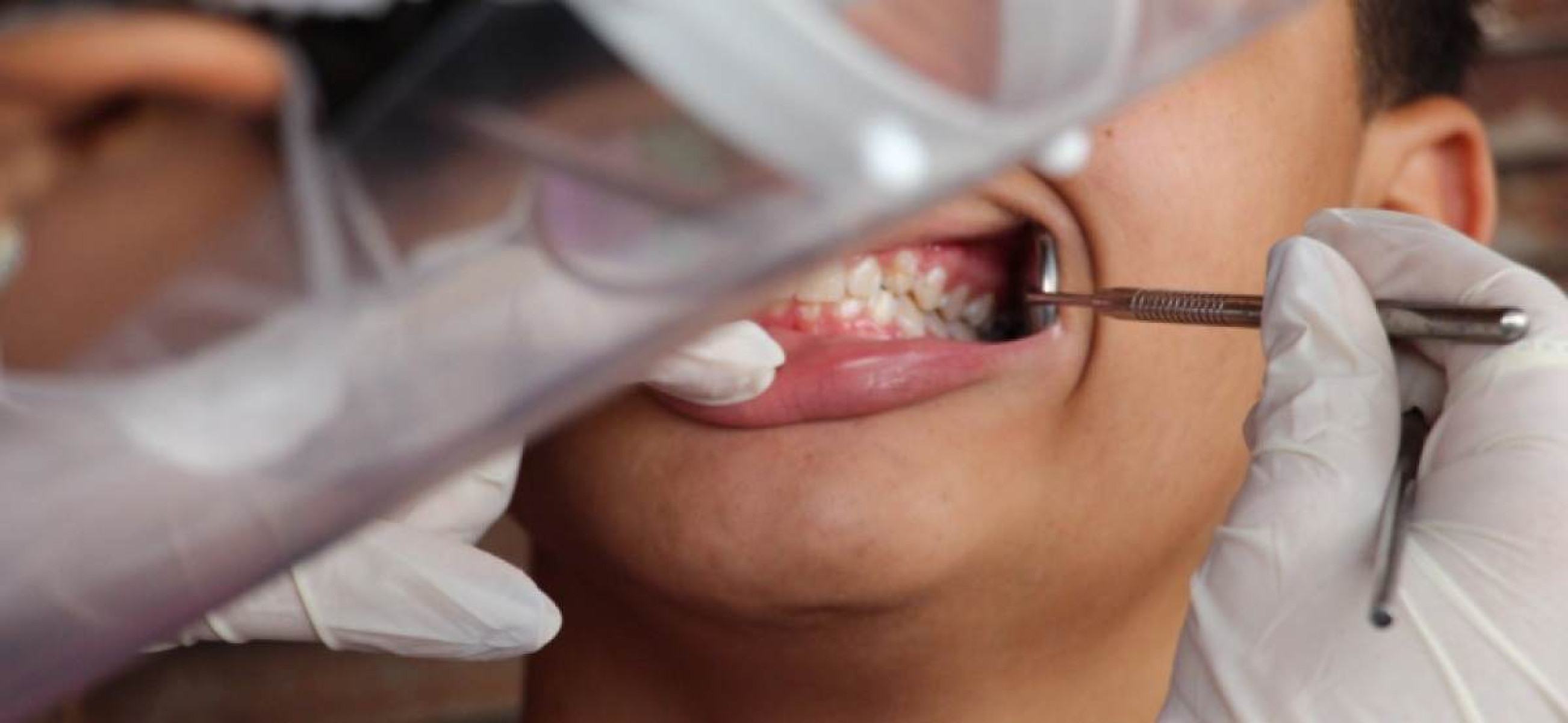 Descoberta substância (secretada por fungos) para combater cárie dental