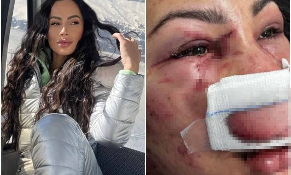 A brasileira Maressa Nunes, 31 anos, foi espancada durante um assalto em Santiago, no Chile -  (crédito: Reprodução/Instagram/Vakinha)