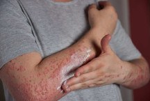 Dermatite atópica: doença não se restringe apenas ao público infantil
