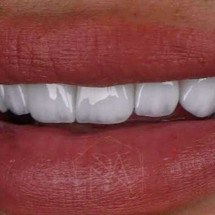  Como evitar um sorriso artificial com as lentes de contato dental - Paulo Antonioli/Arquivo Pessoaç