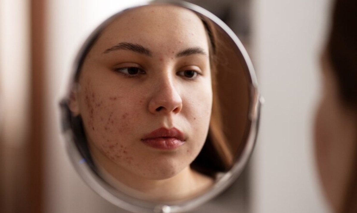 Acne se torna cada vez mais comum entre mulheres adultas
 -  (crédito: DINO)