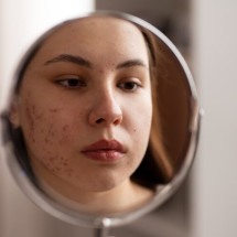 Acne se torna cada vez mais comum entre mulheres adultas
 - DINO