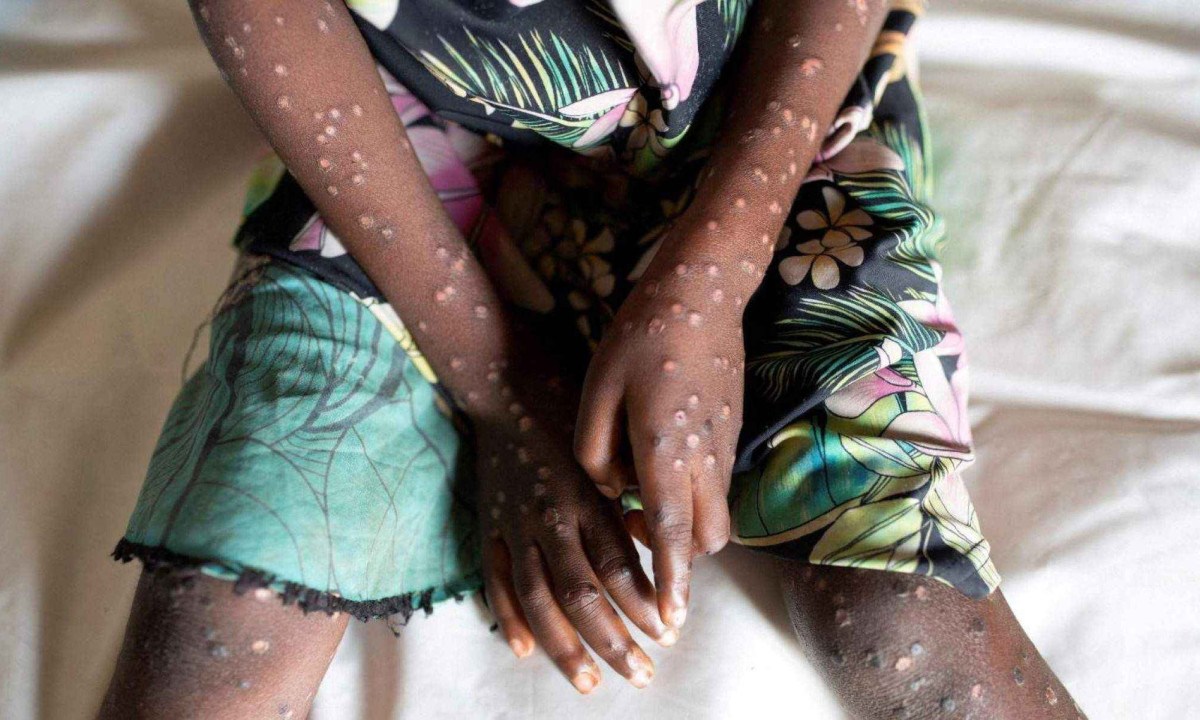 O vírus monkeypox é transmitido através do contato próximo com pessoas infectadas -  (crédito: BBC )