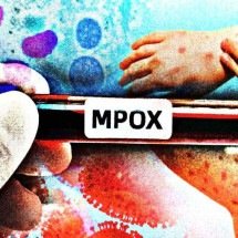 Novo caso de Mpox em Porto Alegre é confirmado; entenda - Maurenilson Freire