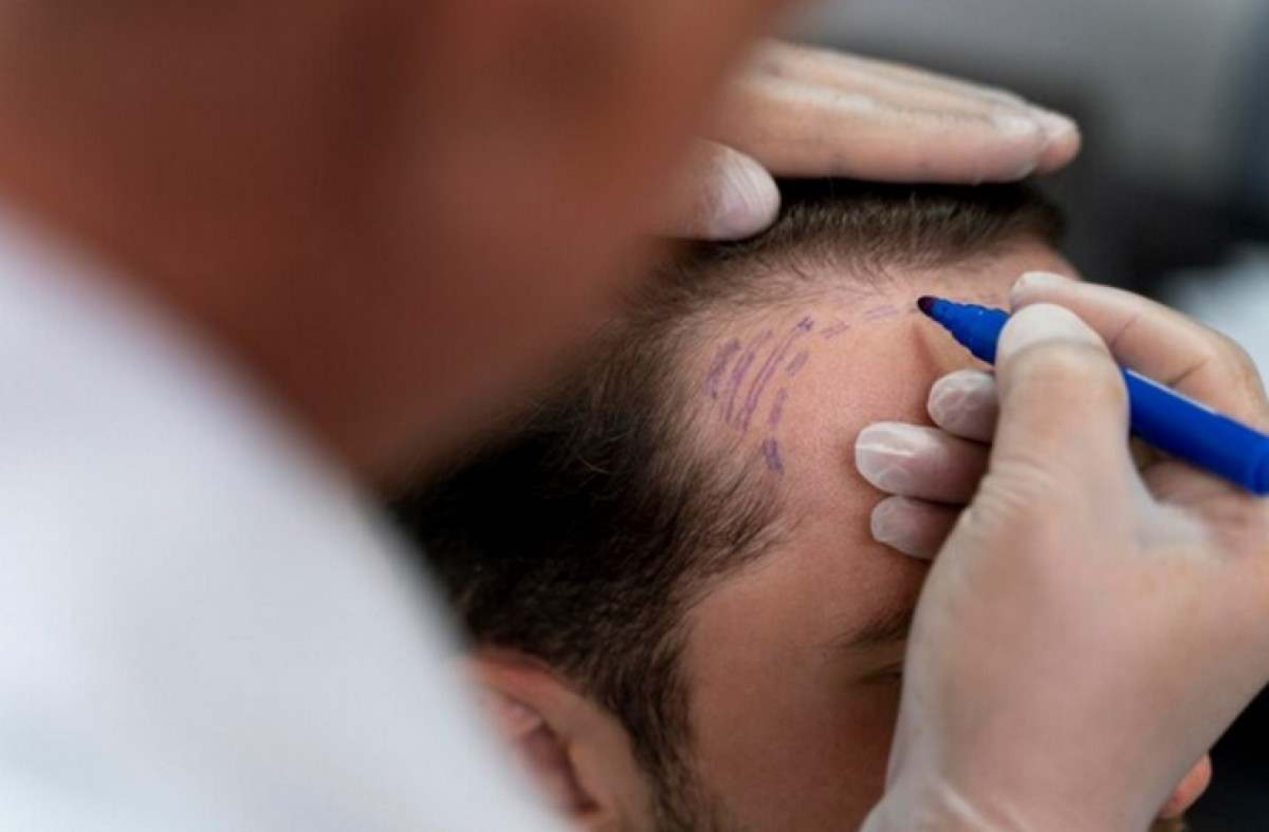 Transplante capilar: quais exames o médico deve pedir no pré-operatório?