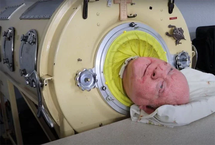 Homem morreu após viver 7 décadas com pulmão de ferro