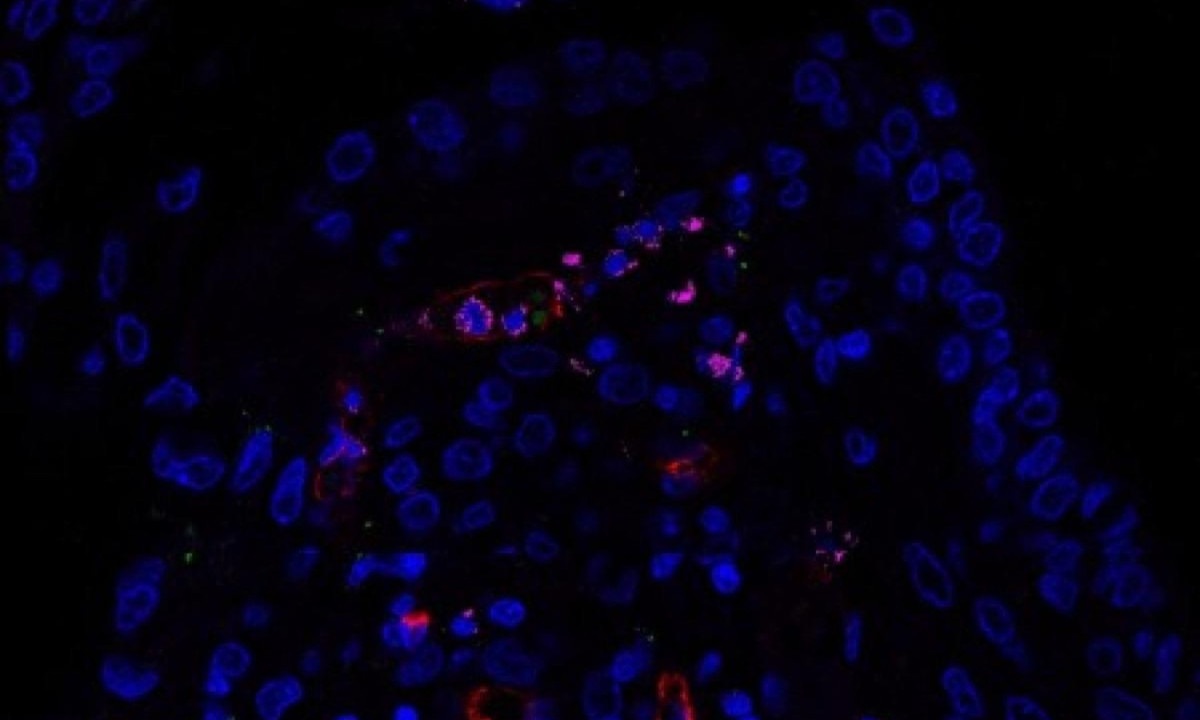 Na autopsia de tecido pulmonar infectado por SARS-CoV-2 foi possível visualizar células endoteliais (vermelho), o inflamassoma ativo (verde) e o RNA do SARS-CoV-2 (rosa), um indicativo de que o vírus estava se replicando -  (crédito: Keyla de Sá/ Divulgação )