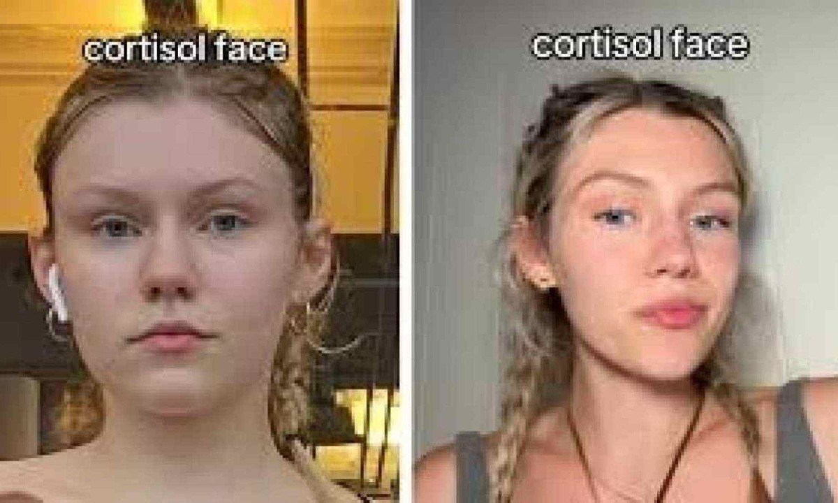 Recentemente, vídeos no TikTok com a hashtag #cortisolface têm popularizado o conceito de 'rosto de cortisol', sugerindo que o inchaço facial seria causado por altos níveis de cortisol -  (crédito: Redes Sociais/ Reprodução)