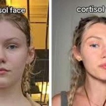 Cortisol Face: o esteroide pode modificar o rosto? - Redes Sociais/ Reprodução