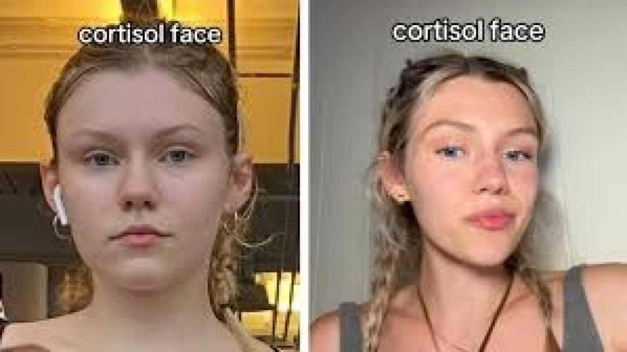 Cortisol Face: o esteroide pode modificar o rosto?