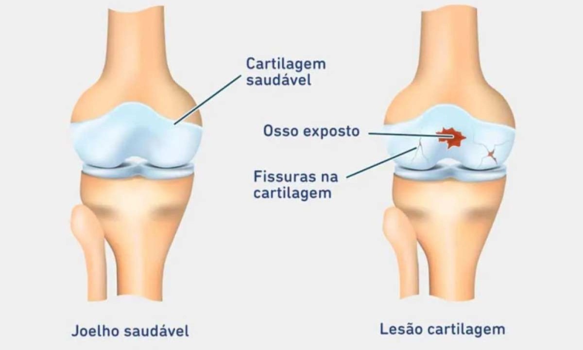 Joelho saudável e joelho com lesão de cartilagem -  (crédito: https://www.bauerfeind.com.br/Reprodução)