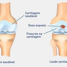 Uso de biológicos nas lesões de cartilagem - https://www.bauerfeind.com.br/Reprodução