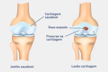 Uso de biológicos nas lesões de cartilagem