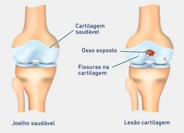 Joelho saudável e joelho com lesão de cartilagem -  (crédito: https://www.bauerfeind.com.br/Reprodução)