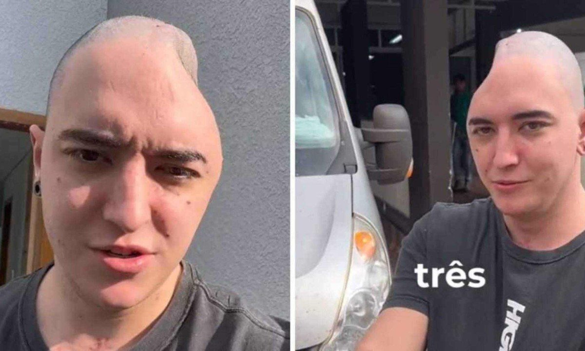 João Cris sofreu um acidente com um monociclo e ficou com o crânio deformado -  (crédito: Reprodução/Redes sociais)