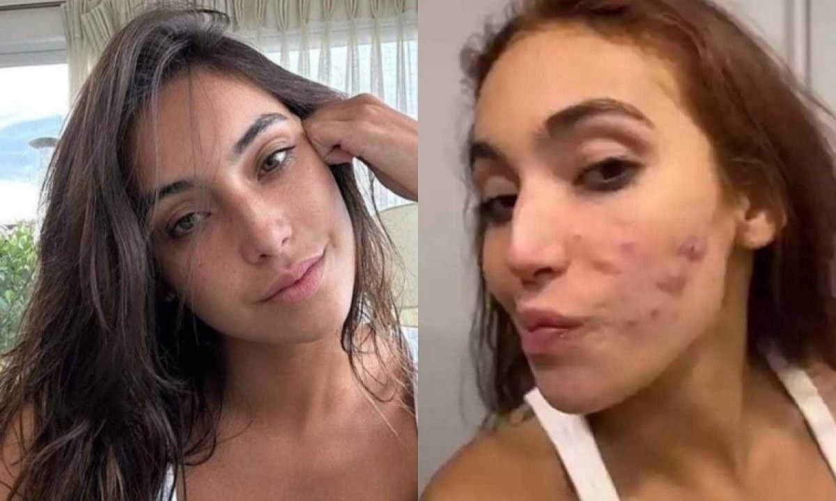 As espinhas vermelhas e brilhantes não são apenas um problema dos adolescentes, mas, independentemente de quando - ou como - elas aparecem, o impacto não é superficial -  (crédito: Instagram)