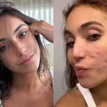 Vanessa Lopes desabafa sobre acne: "Minha autoestima está lá embaixo" - Instagram