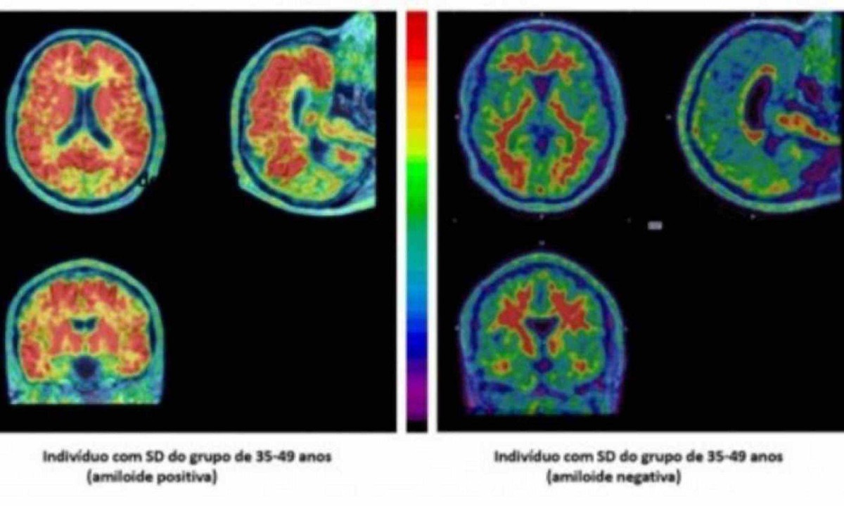 Estudo avaliou o cérebro de indivíduos com síndrome de Down de diferentes faixas etárias -  (crédito: Daniele de Paula Faria)