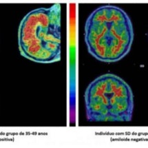 Síndrome de Down: técnica de medicina nuclear estuda Alzheimer nesse grupo - Daniele de Paula Faria