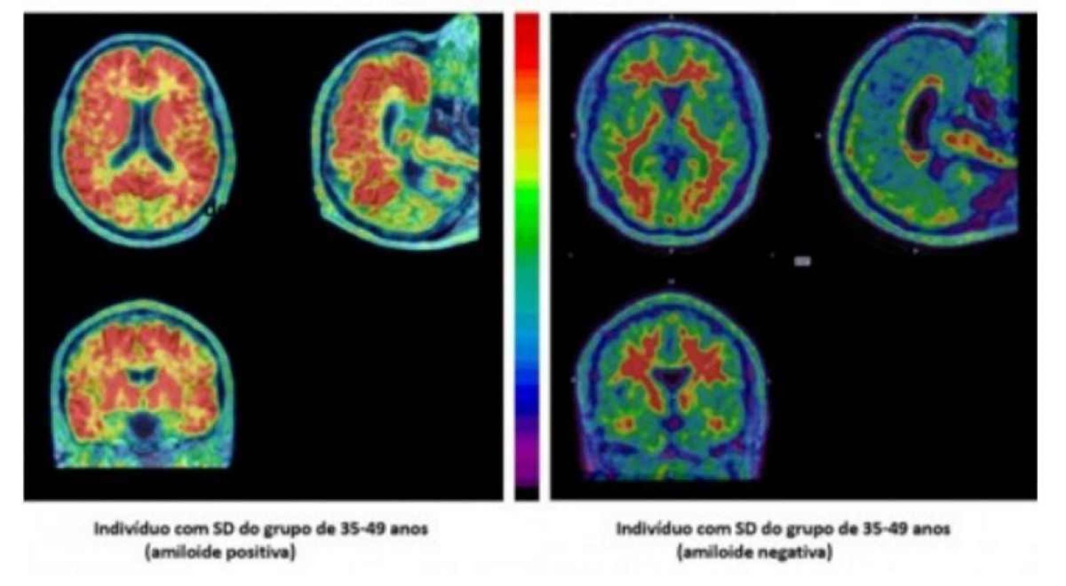 Síndrome de Down: técnica de medicina nuclear estuda Alzheimer nesse grupo