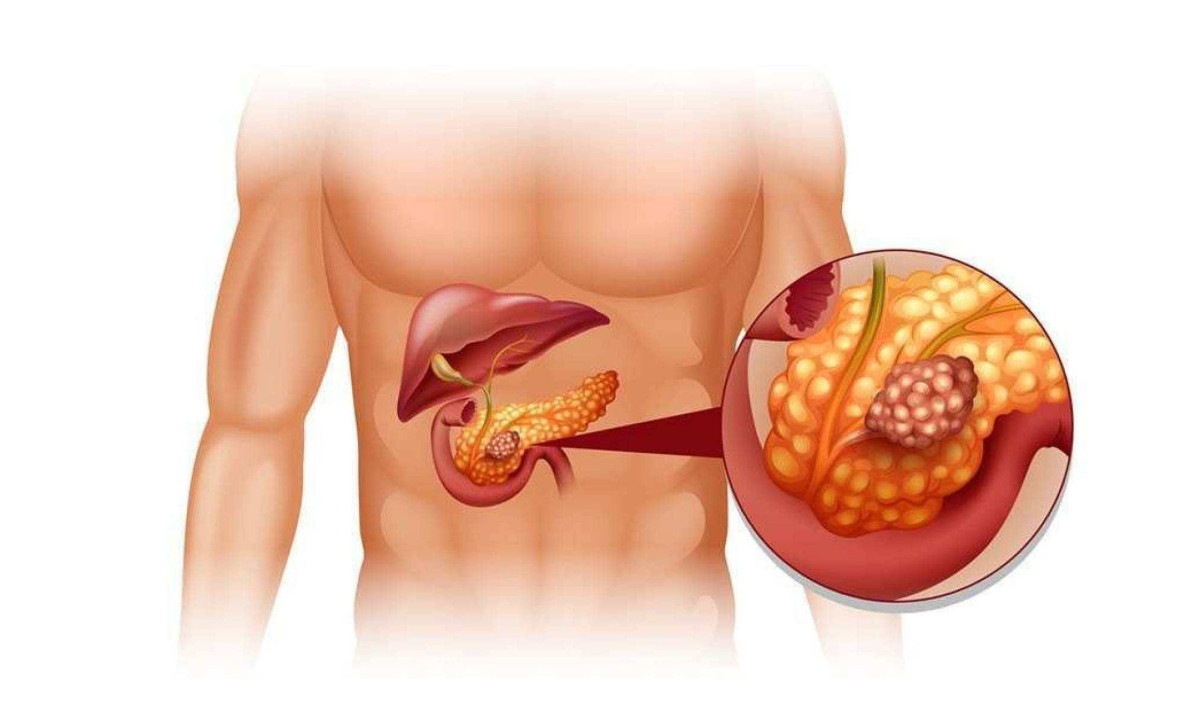 O adenocarcinoma ductal pancreático (PDAC) é uma doença mortal com incidência crescente -  (crédito: drmarcelocruz.com.br/Reprodução)