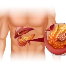 Rastreamento do câncer de pâncreas para indivíduos de risco - drmarcelocruz.com.br/Reprodução