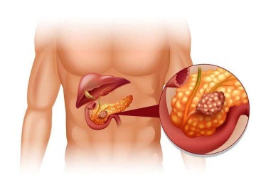 O adenocarcinoma ductal pancreático (PDAC) é uma doença mortal com incidência crescente -  (crédito: drmarcelocruz.com.br/Reprodução)