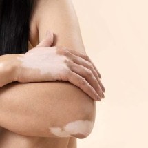 Mancha branca: vitiligo, hanseníase ou pitiríase versicolor? Veja diferença - Freepik