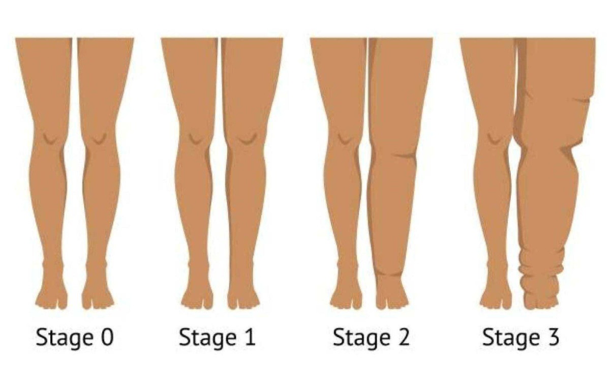  Women's legs in different stages of Lymphedema. Vector illustration
     -  (crédito:  Getty Images)