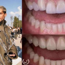 Namorado de Bruna Marquezine faz procedimento para escurecer os dentes - Reprodução / Instagram