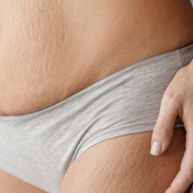  Cinco tratamentos que não funcionam para estrias - Freepik