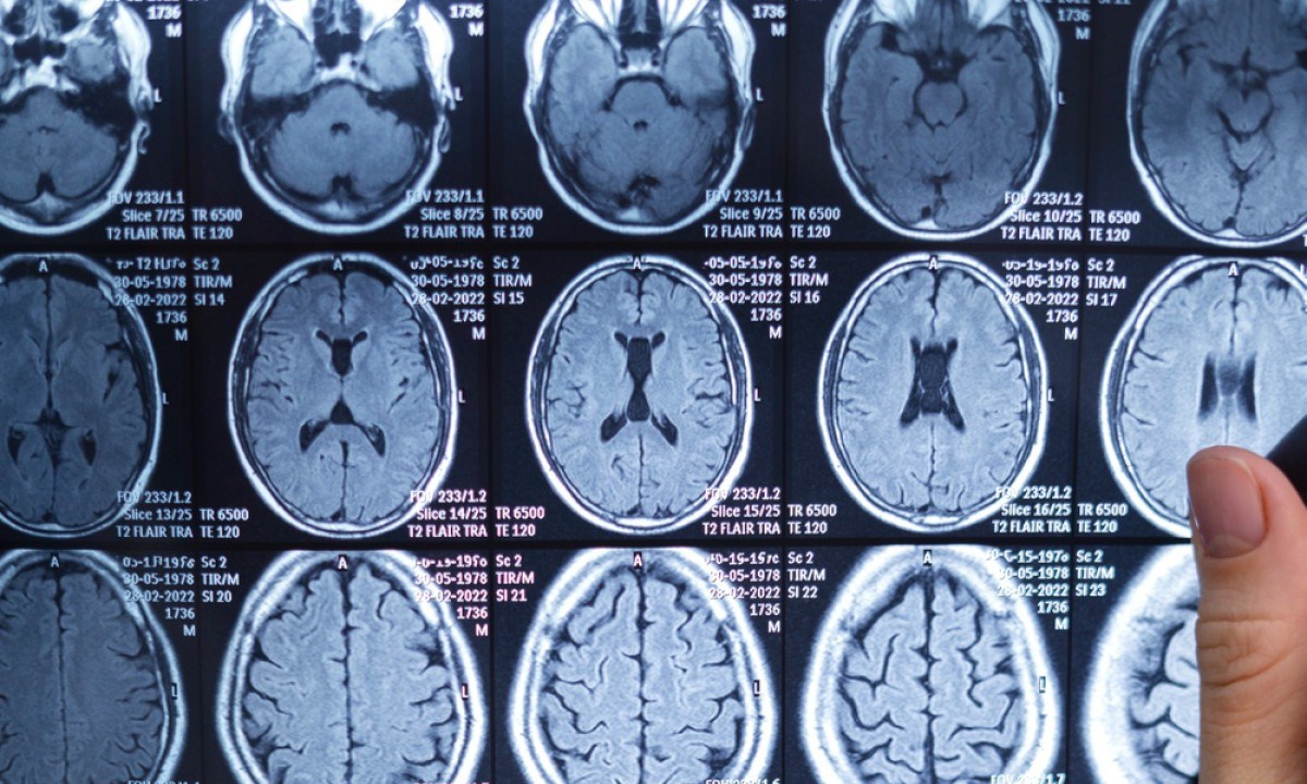 Neurocirurgião esclarece dúvidas sobre tumor cerebral  -  (crédito: DINO)