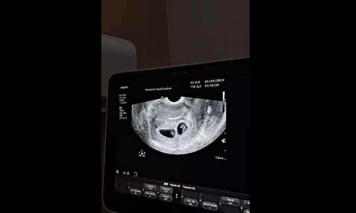 Foram necessÃ¡rios dois exames de ultrassom para descobrir os quadrigÃªmeos -  (crédito: ReproduÃ§Ã£o / MÃ­dias Sociais)