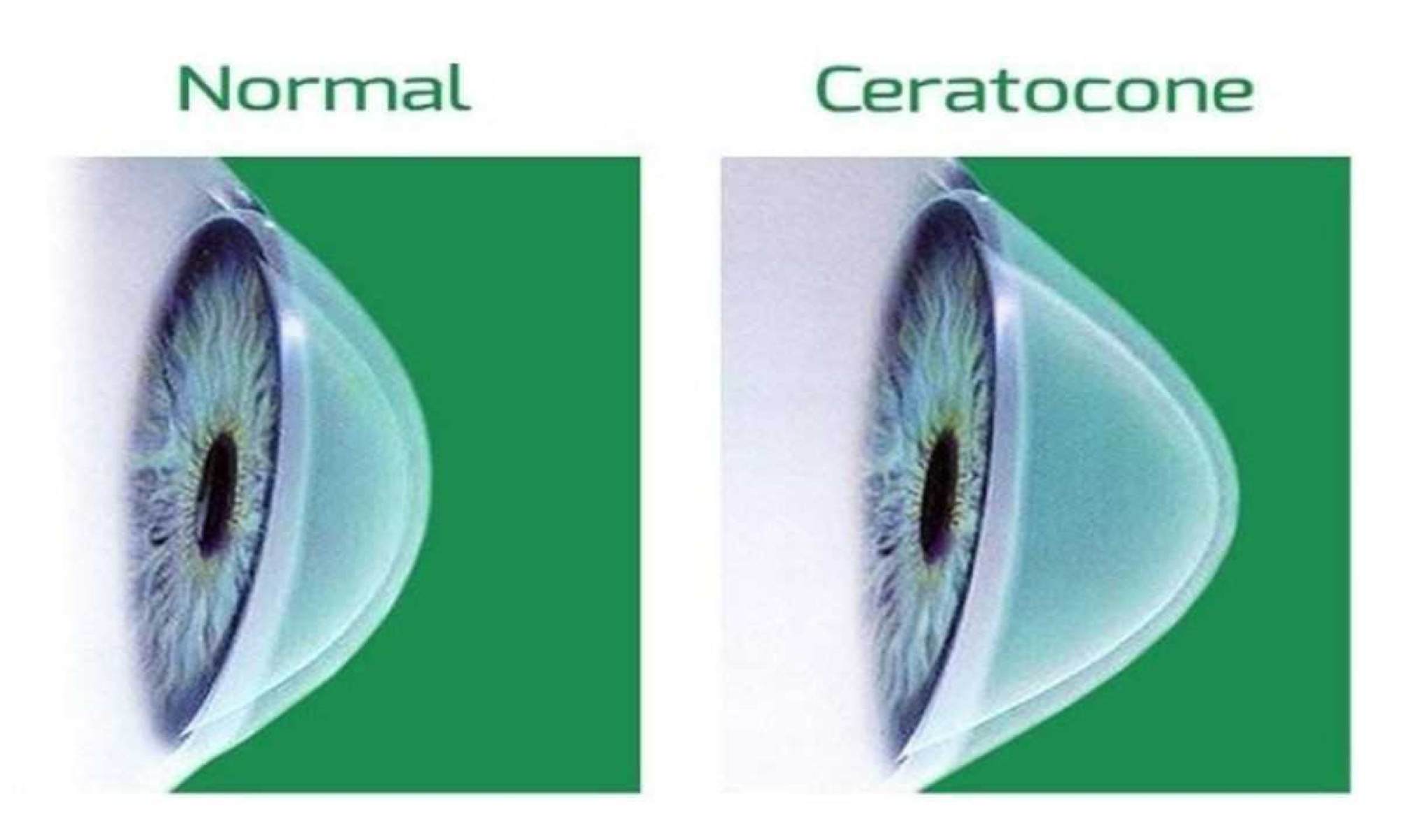 Alteração na córnea com o ceratocone